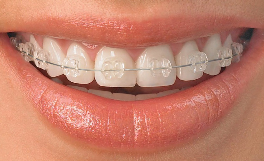 Brackets estéticos