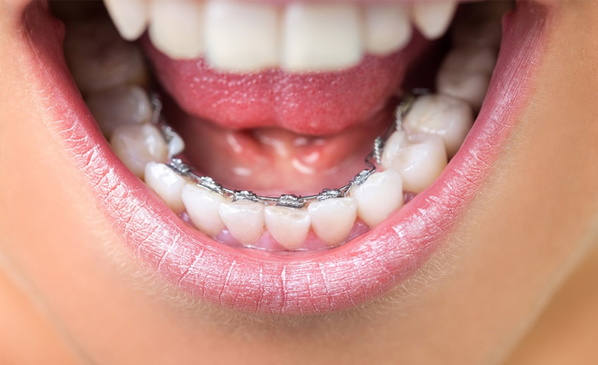 Brackets linguales