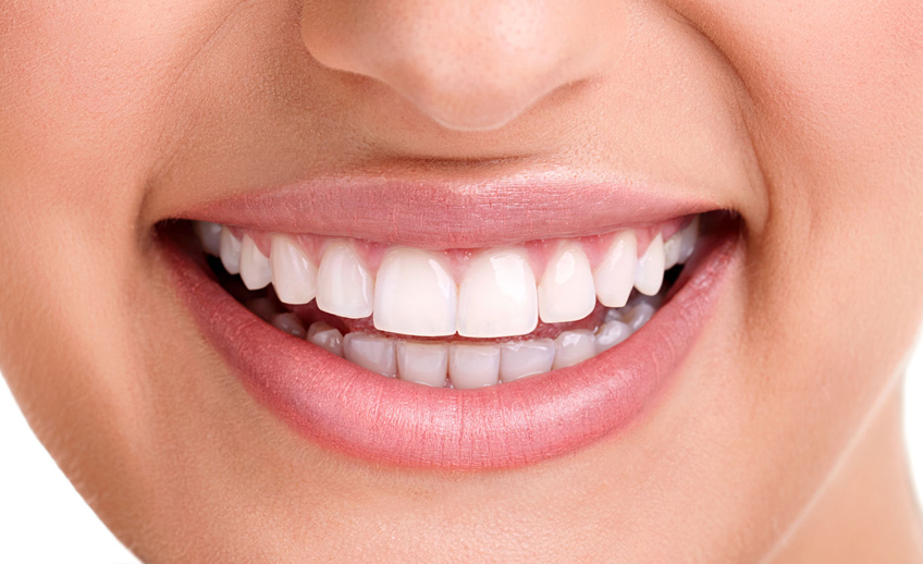 Blaqueamiento Dental