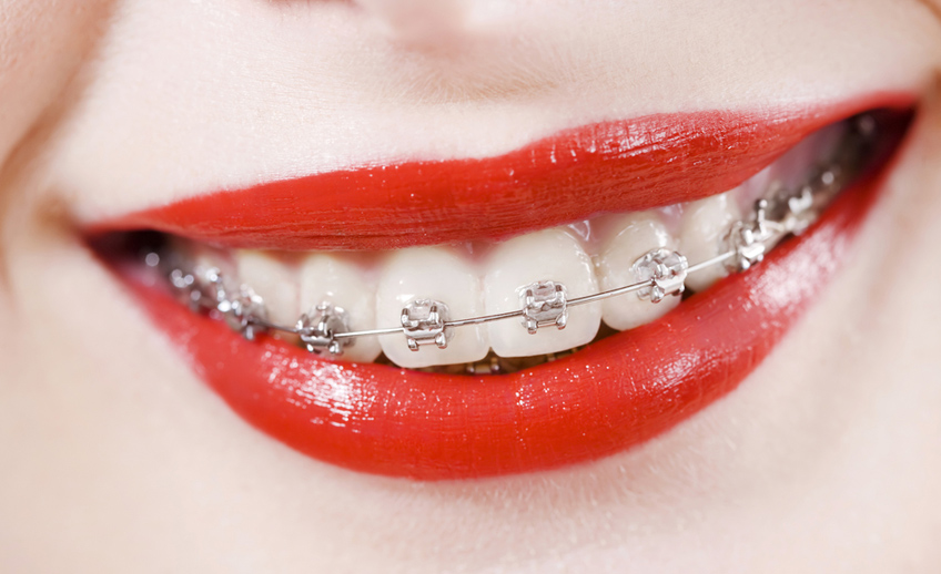 Brackets autoligables