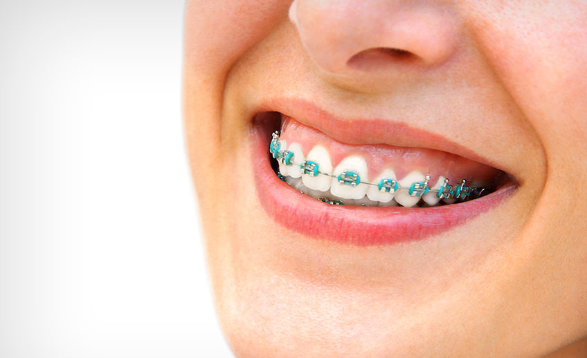 Brackets convencionales
