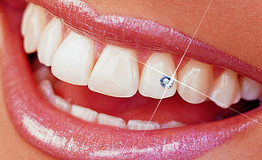 Piercing Dentales
